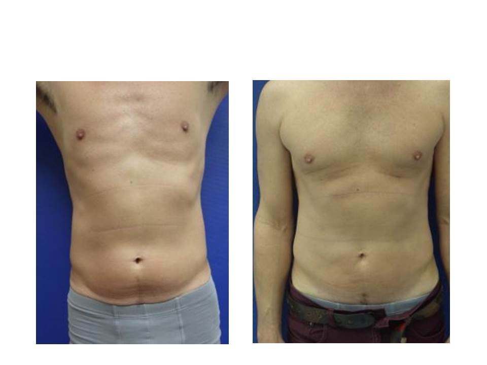 Liposuction Advanced Specialty Care