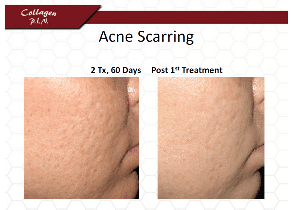 MicroNeedling and PRP Advanced Specialty Care